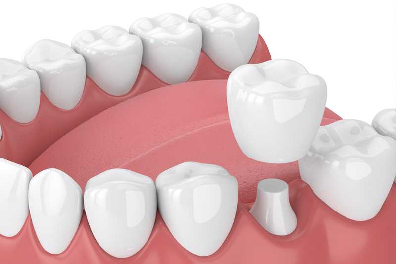 Dental Crowns in Morgan City